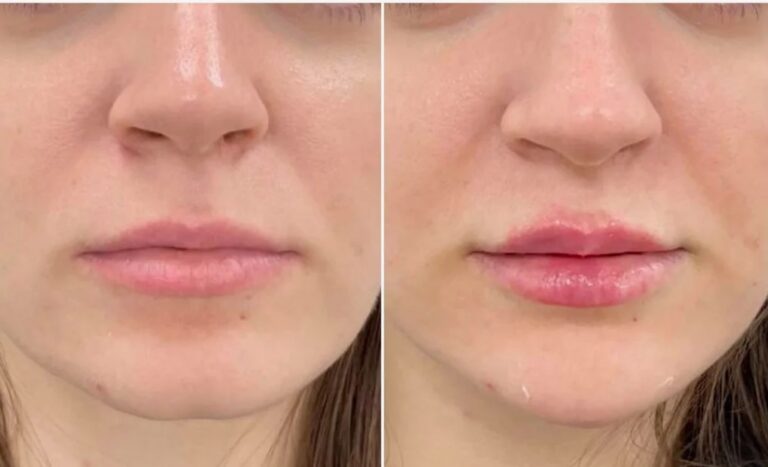 chin-fillers-before-after