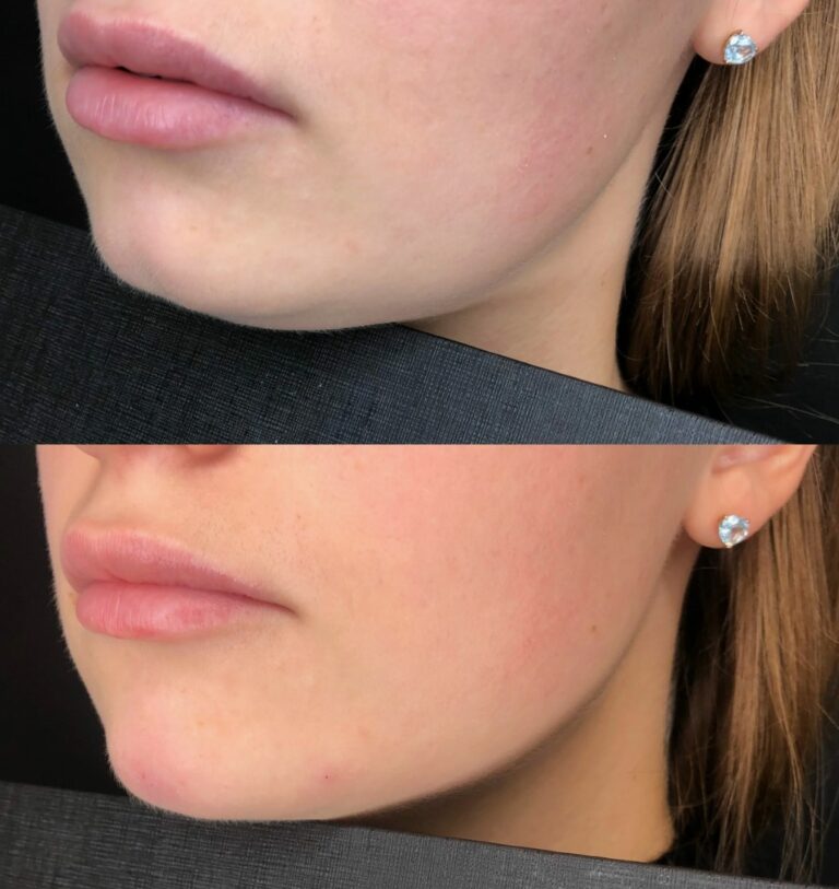 Chin fillers aesthetic enhancement before after with more defined lower face.
