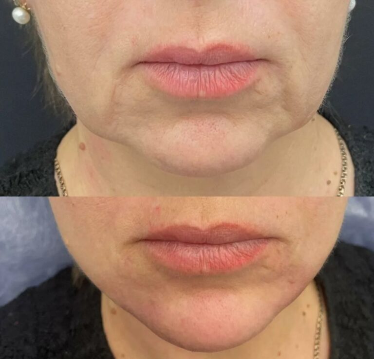 Chin fillers before after with improved chin projection and balanced facial profile.