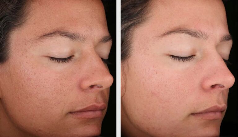 Customised Deluxe HydraFacial tailored to individual skin needs.