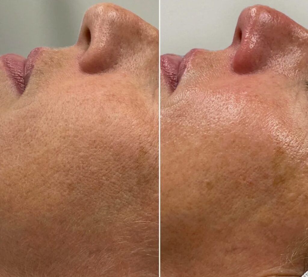 Professional Deluxe HydraFacial facial treatment performed in clinic.