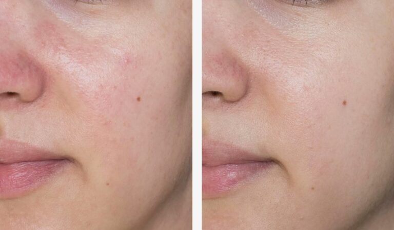 Deluxe HydraFacial treatment carried out in a professional clinic.