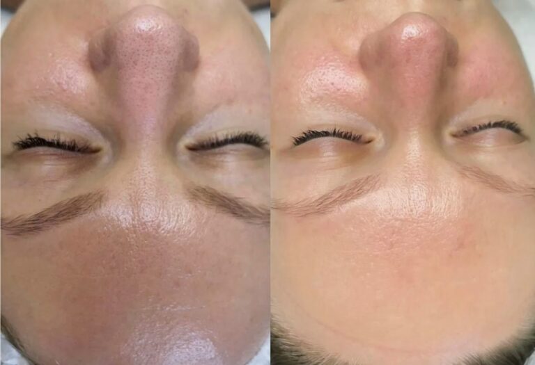 Skin renewal and smoother texture achieved with Deluxe HydraFacial.