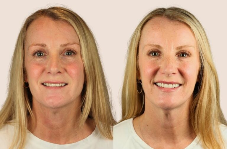 Comprehensive aesthetic approach used in a Full Facial Makeover.