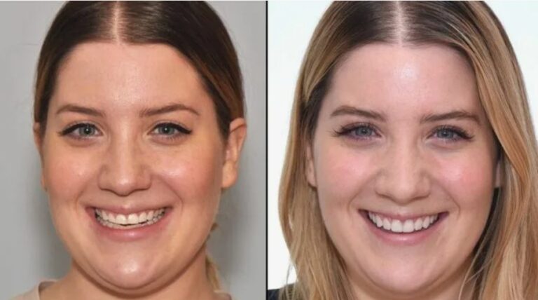 Facial balancing achieved with a personalised Full Facial Makeover.