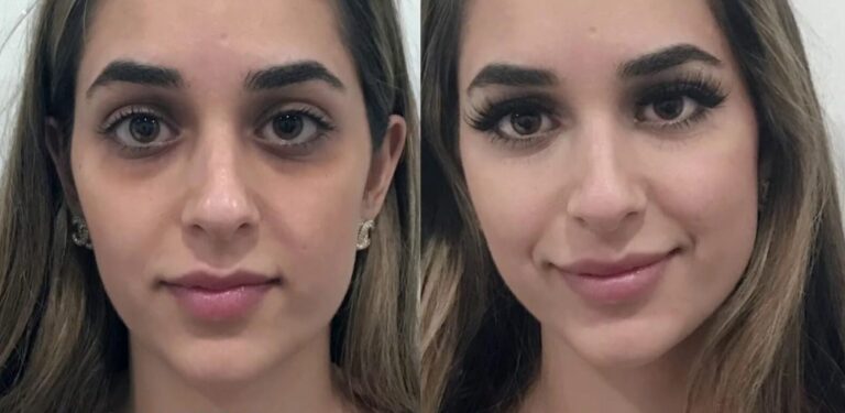 Full Facial Makeover treatment plan tailored to individual facial features.