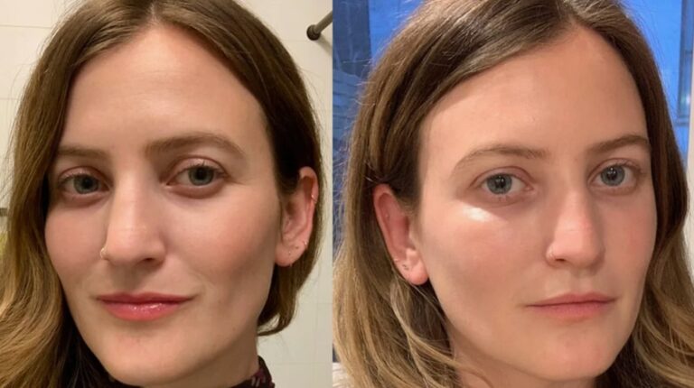 Before and after results of Glow & Go Facial treatment.