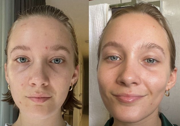 Smoother skin texture following Glow & Go Facial treatment.