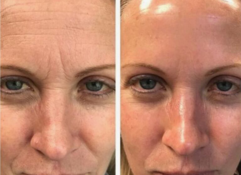 Before and after results of HydraFacial Treatment for clearer skin.