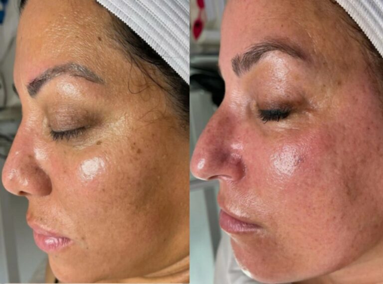 Professional HydraFacial Treatment performed as a facial procedure.