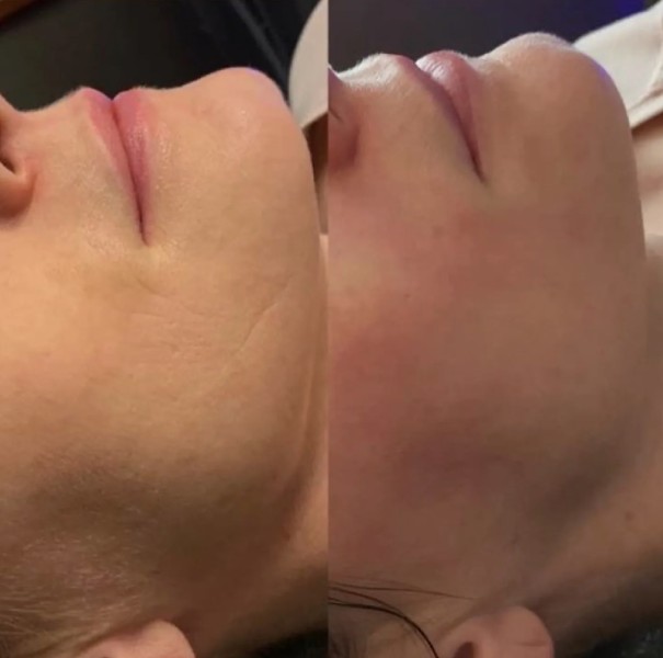 Glow enhancing facial with advanced HydraFacial Treatment.