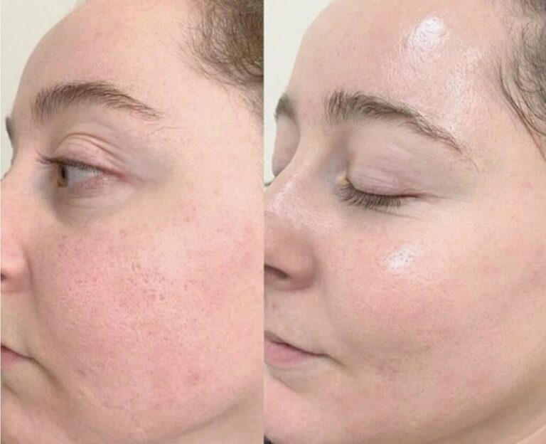 HydraFacial Treatment for deep skin cleansing and hydration.