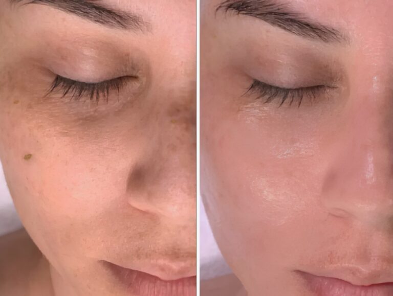 Skin hydration and glow achieved with HydraFacial Treatment.