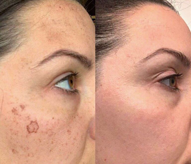Before and after results of IPL Skin Rejuvenation treatment.
