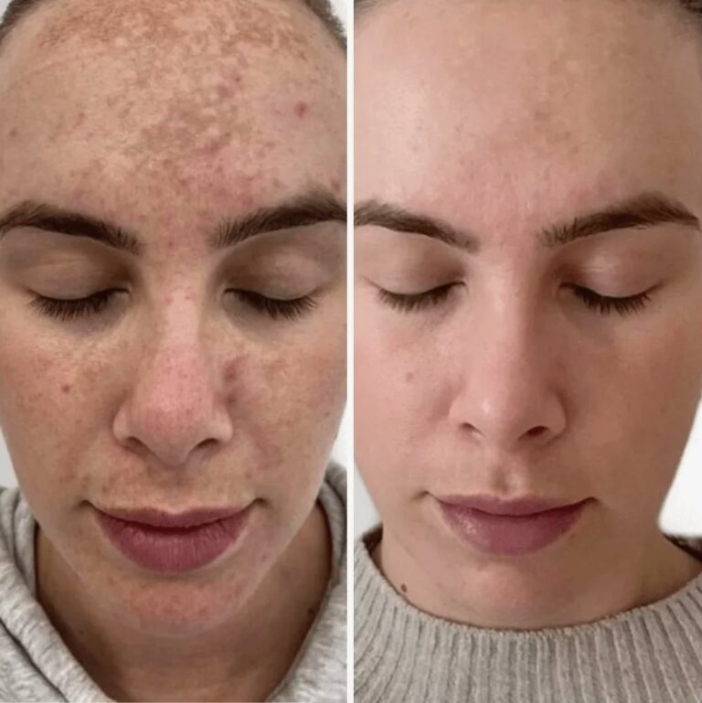 Facial IPL Skin Rejuvenation treatment to refresh and brighten the skin.