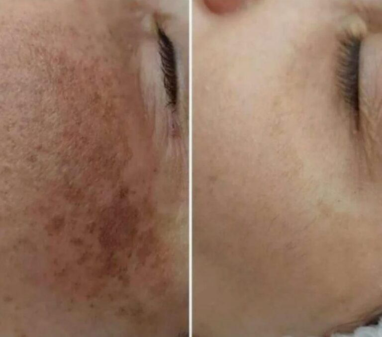Pigmentation care supported by IPL Skin Rejuvenation treatment.