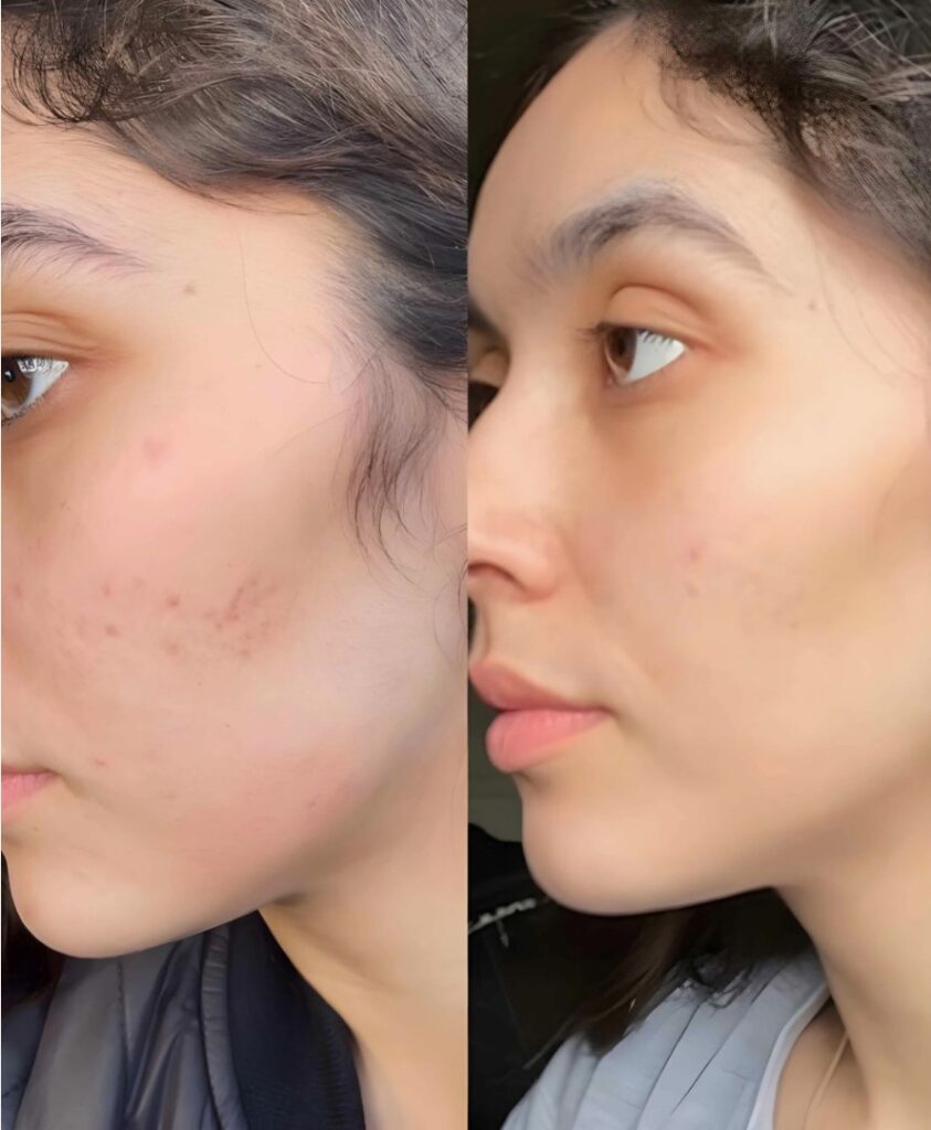 IPL Skin Rejuvenation carried out in a professional aesthetic clinic.