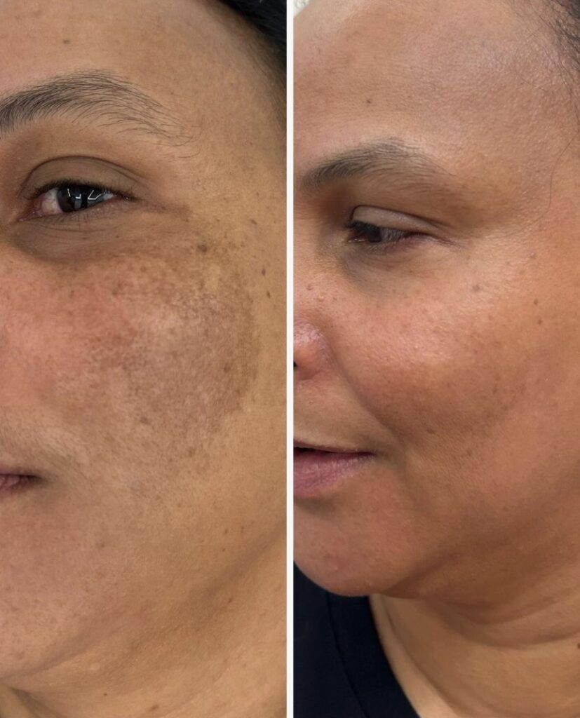 Redness reduction and skin balance with IPL Skin Rejuvenation.