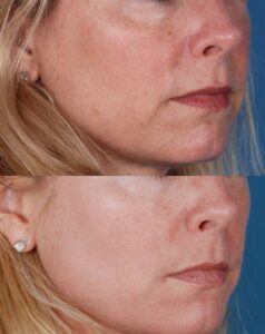 IPL Face Treatments⚕️London Cost £75 [Before & After]