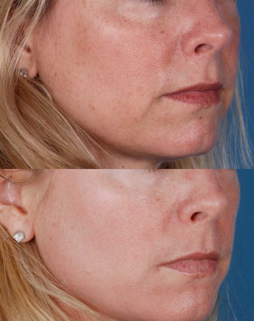 Improved skin texture achieved with IPL Skin Rejuvenation.
