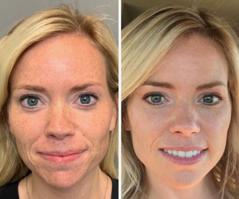 Sun damage care supported by IPL Skin Rejuvenation treatment.