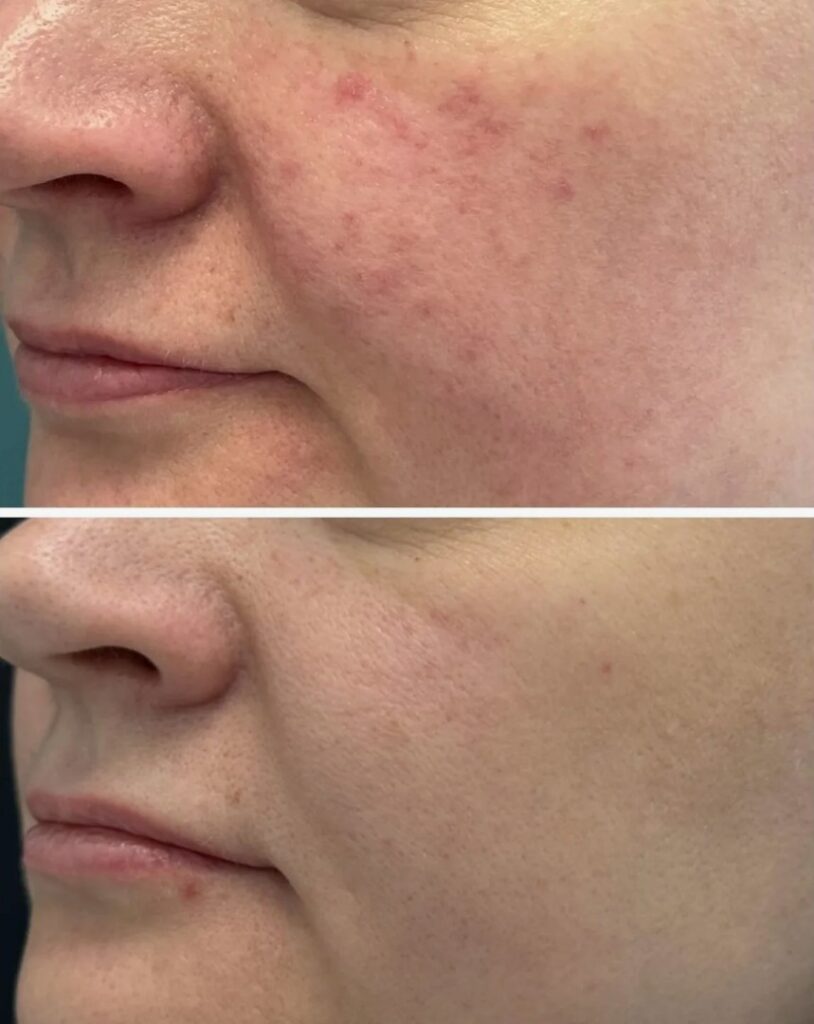 IPL Skin Rejuvenation treatment to improve skin tone and clarity.