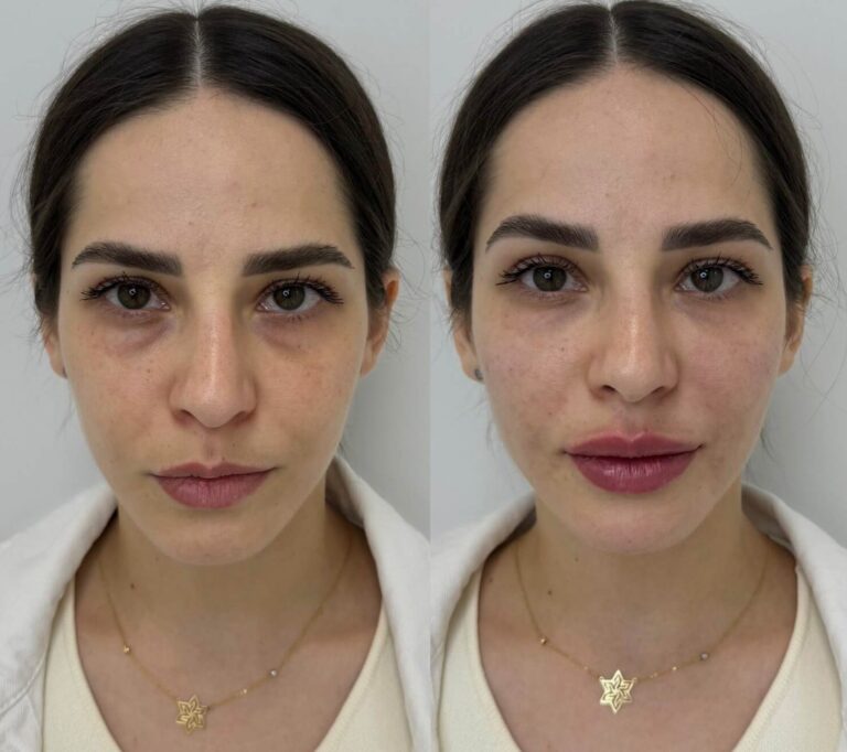 Anti aging skin treatment using Juvéderm Volite injectable solution