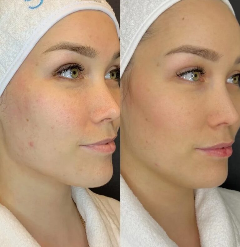 Facial Juvéderm Volite injections to improve skin quality and elasticity