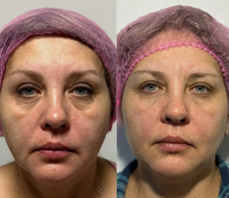 Juvéderm Volite treatment for long lasting skin hydration and smooth texture