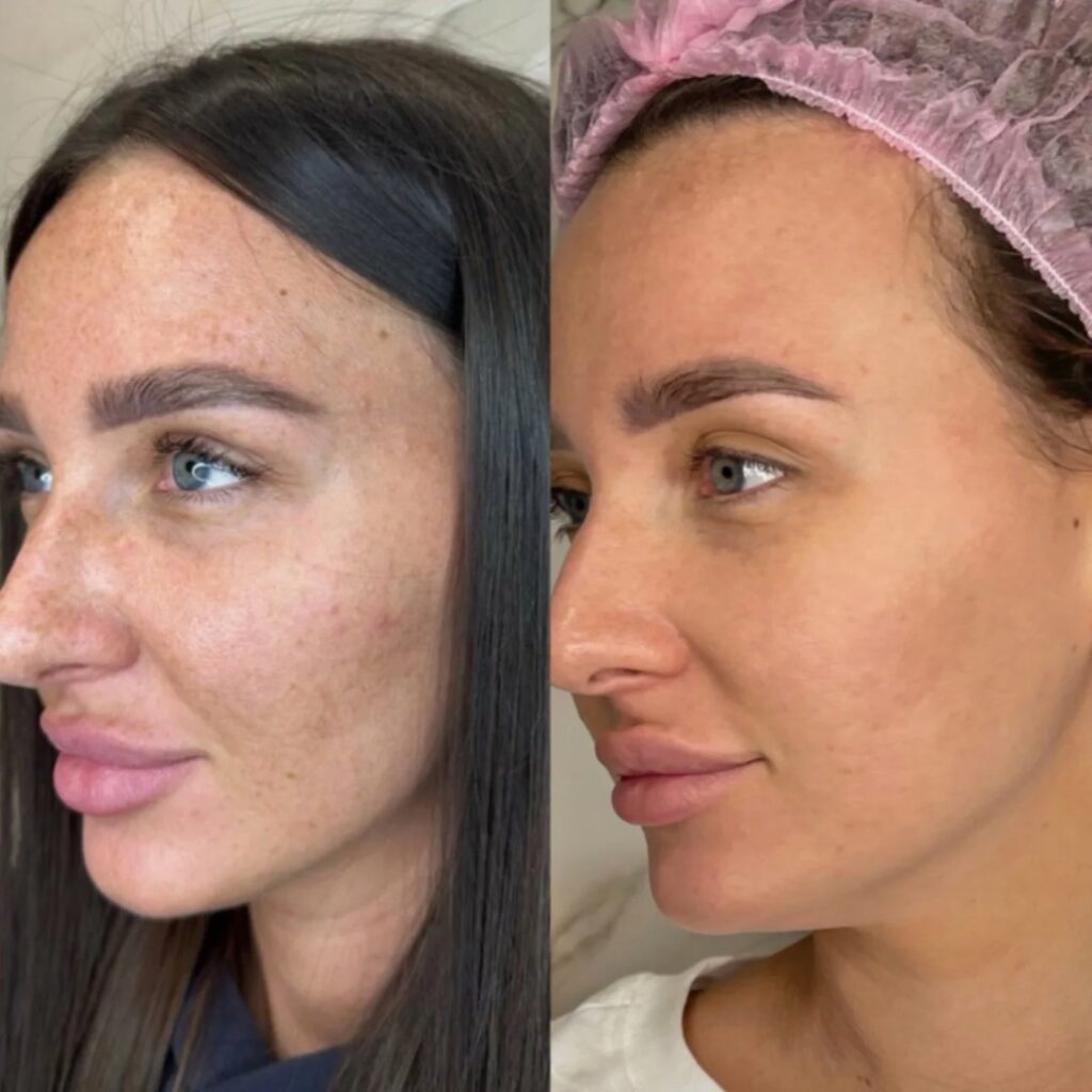 Before and after results of Lumecca IPL skin treatment.