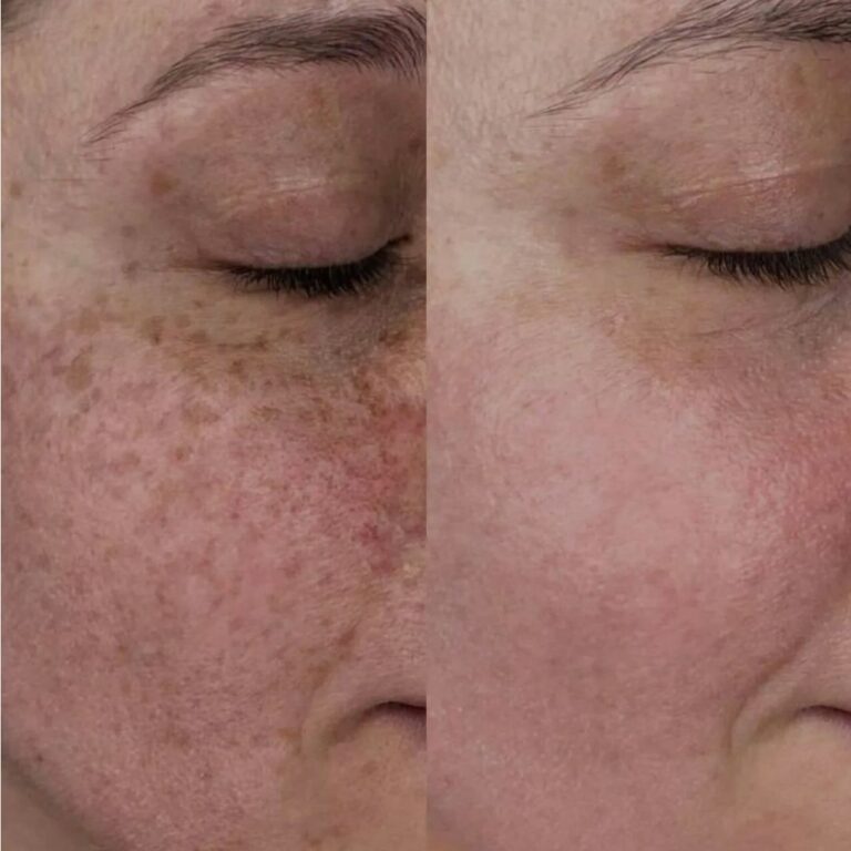 Non invasive skin rejuvenation with Lumecca IPL treatment.