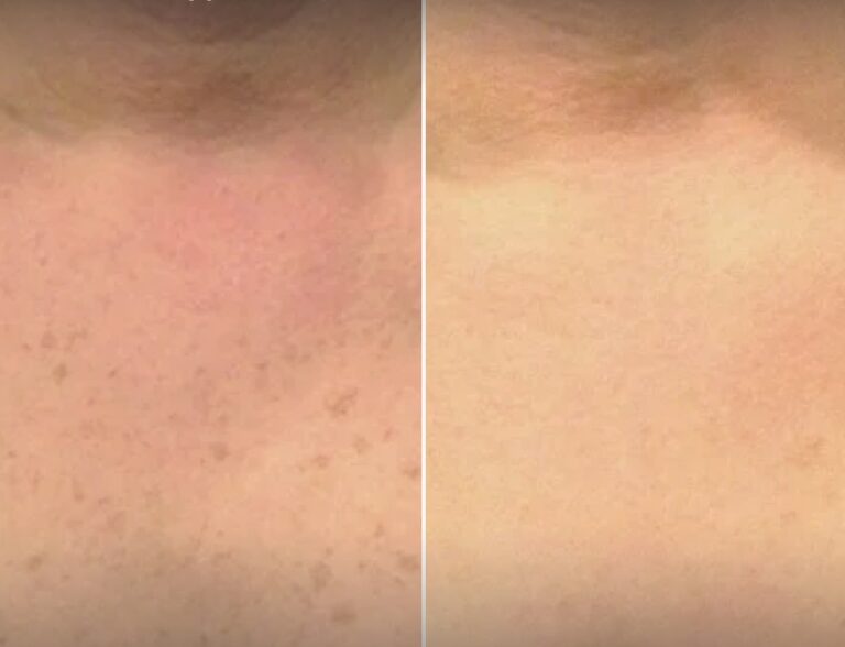lumecca-ipl-pigmentation-treatment