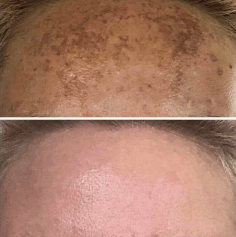 Redness and uneven tone reduction using Lumecca IPL.