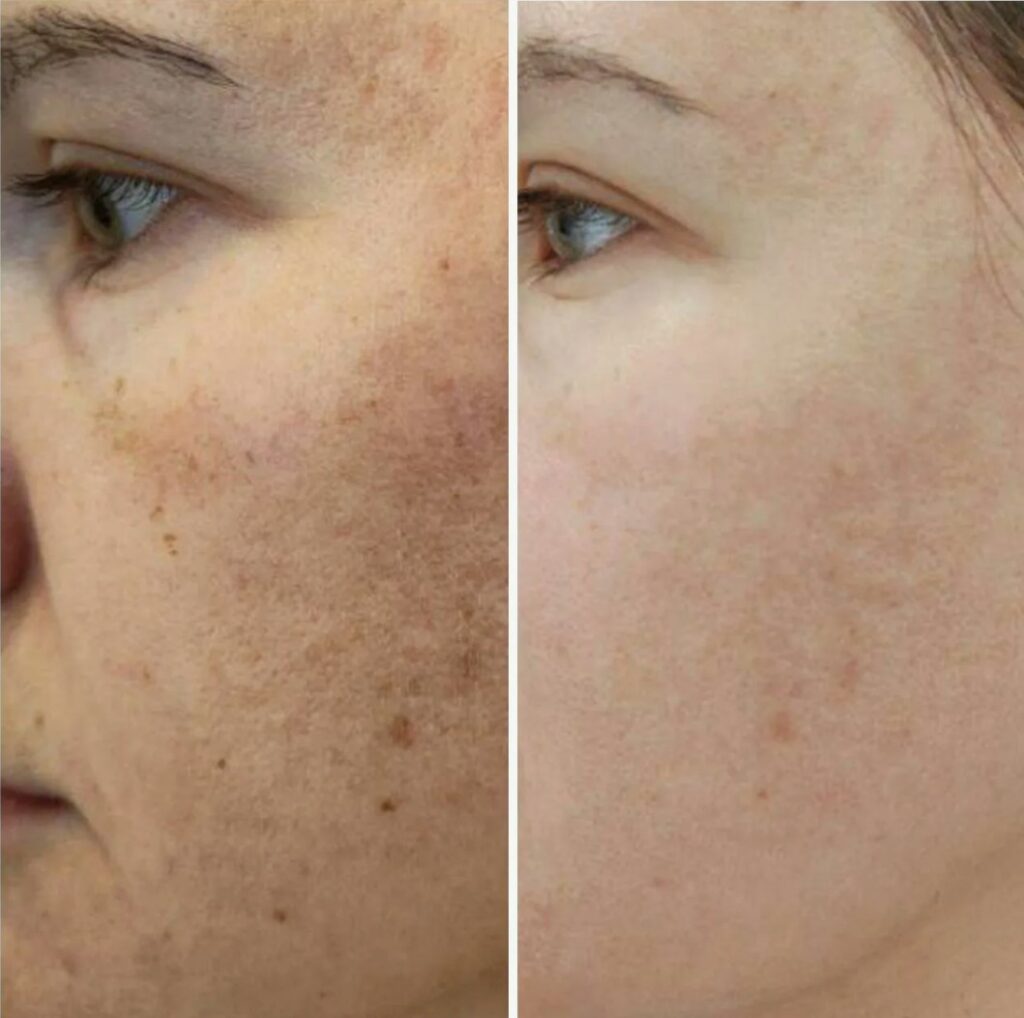 Lumecca IPL treatment to improve skin tone and clarity.
