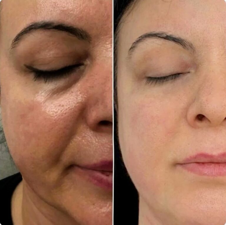 Anti-aging mesotherapy solution for smoother and brighter skin.