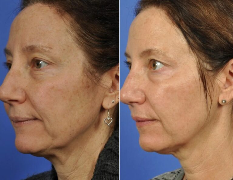 Before and after results of mesotherapy for healthier looking skin.