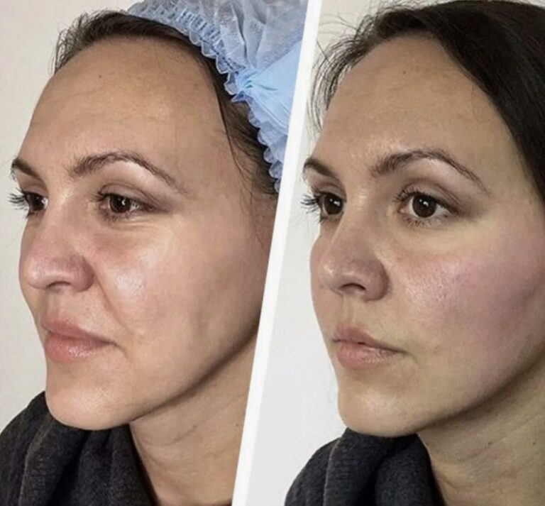 Mesotherapy treatment to support hair and scalp health.