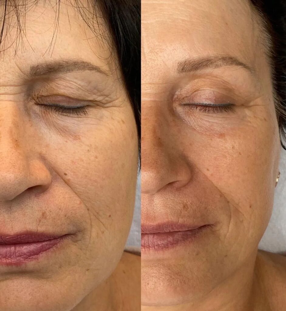 Mesotherapy treatment for skin rejuvenation and improved hydration.