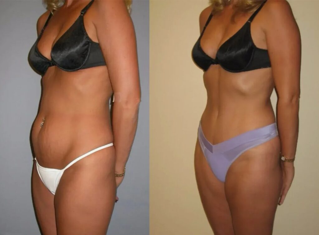 Before and after results of Morpheus8 Body treatment.