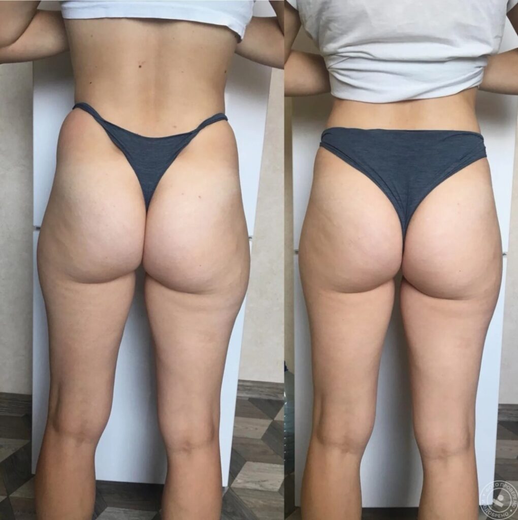 Body contouring support achieved with Morpheus8 Body treatment.