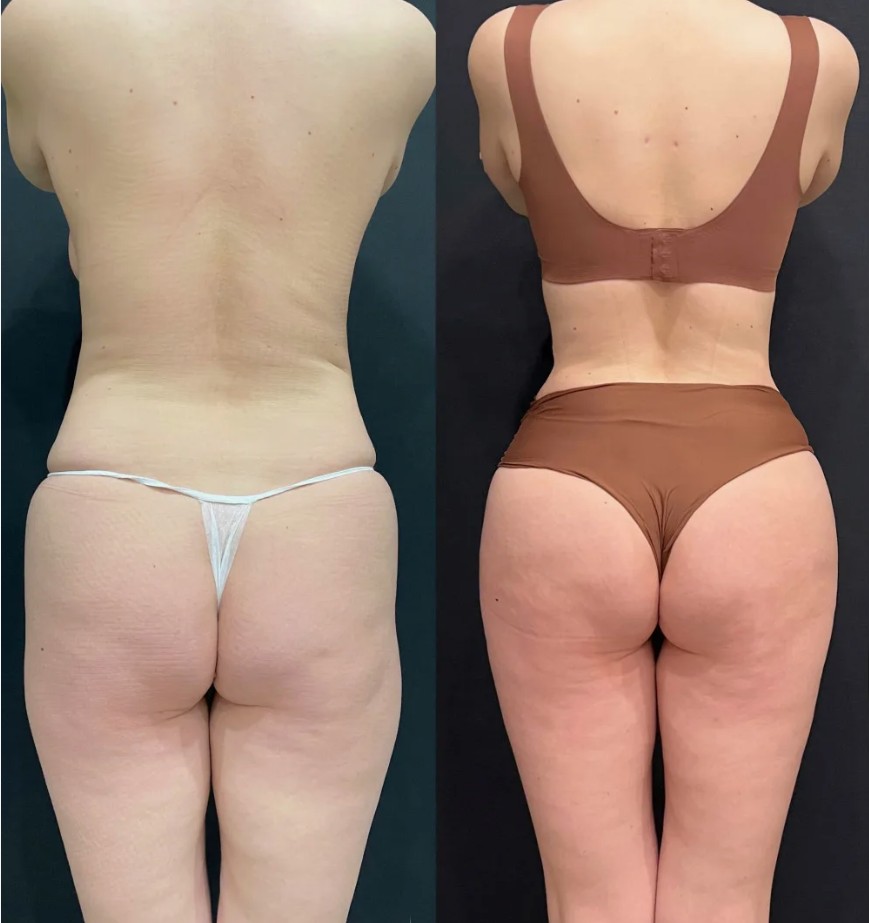 Morpheus8 Body treatment using radiofrequency microneedling for skin tightening.