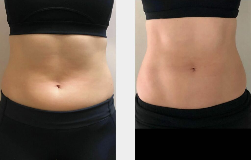 Skin firming and texture improvement with Morpheus8 Body treatment.