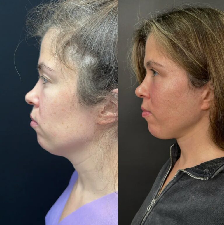 Neck Botox injections performed as part of a Nefertiti Lift procedure.