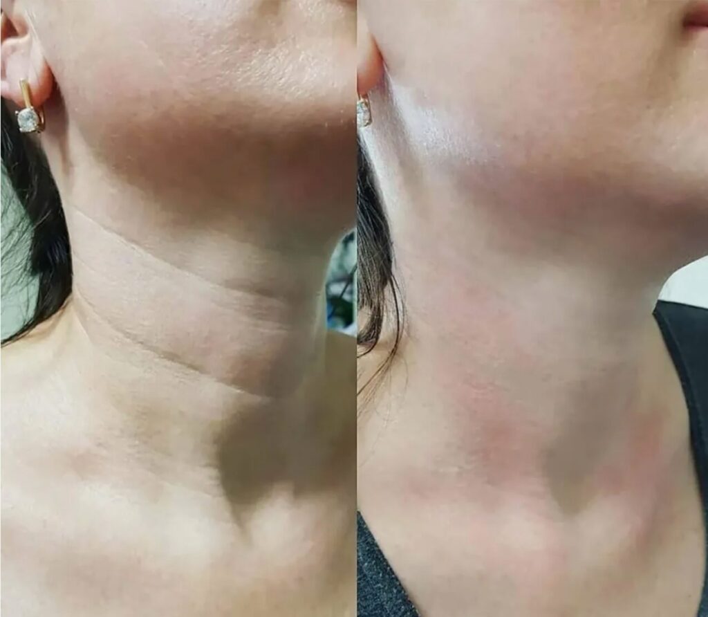 Aesthetic neck rejuvenation with Neck Botox and Nefertiti Lift.