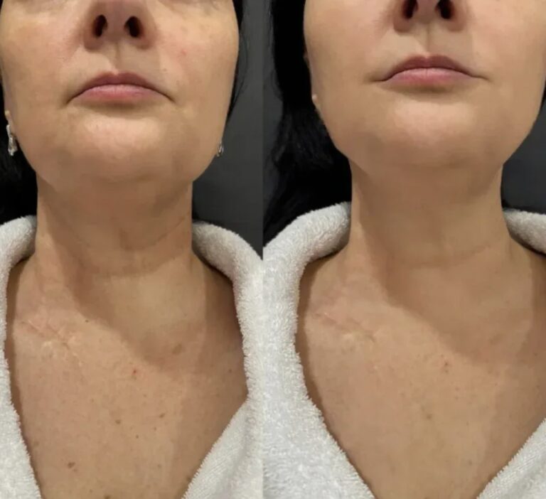 neck-botox-nefertiti-lift-procedure