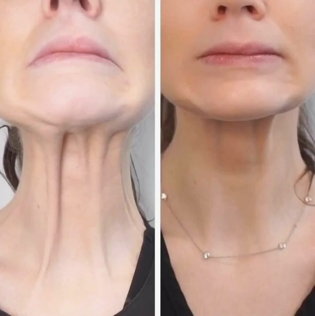 Neck Botox and Nefertiti Lift treatment to improve jawline and neck definition.
