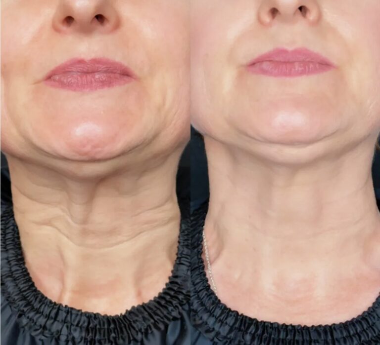 Before and after comparison of Neck Botox with Nefertiti Lift technique.