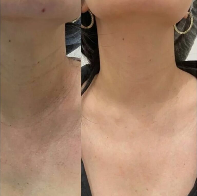 Visible results of Nefertiti Lift using Neck Botox for smoother neck contours.