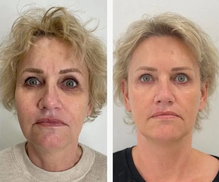 Before and after results of Nucleofill skin treatment
