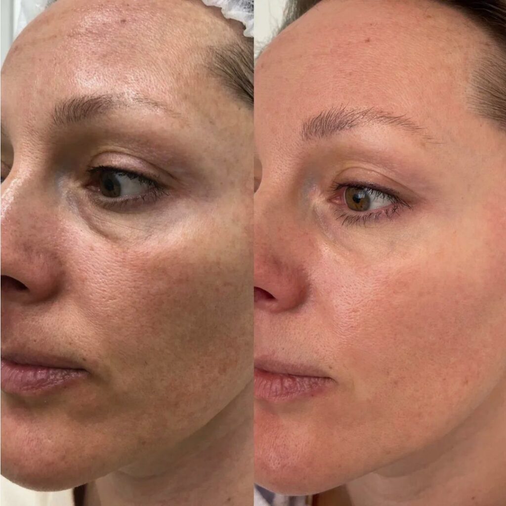 Nucleofill procedure supporting collagen stimulation in the skin.